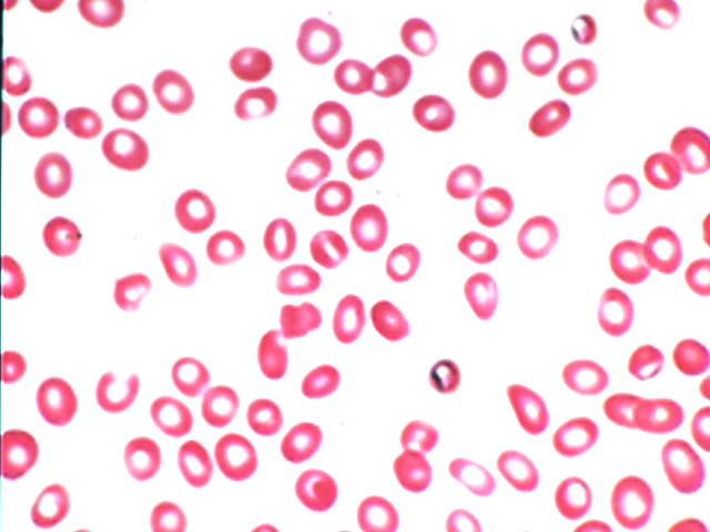 <p>Hypochromic Microcytic Anemia