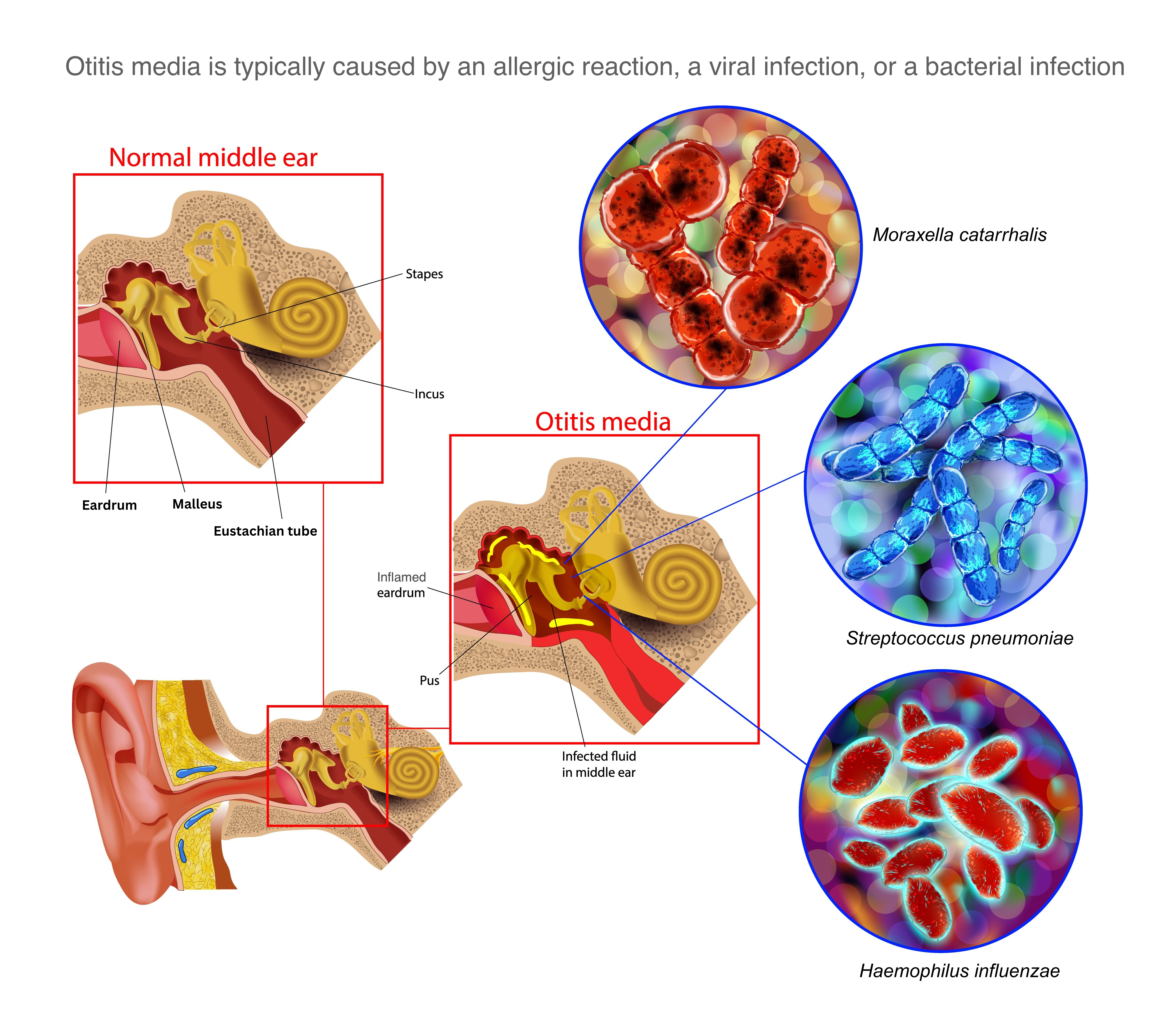 <p>Acute Otitis Media Pathophysiology
