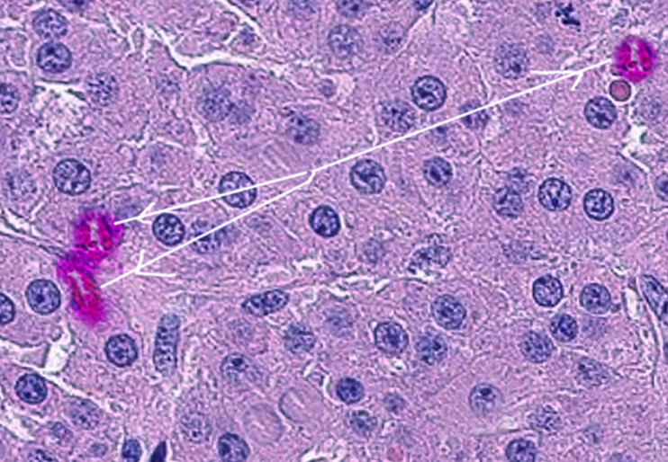 <p>Leydig Cell Tumor