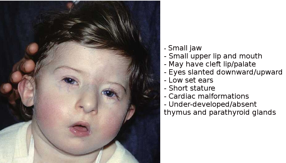 <p>DiGeorge Syndrome