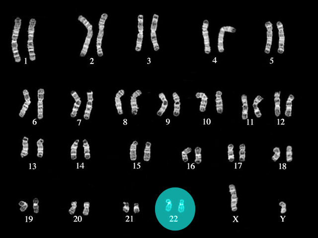 <p>DiGeorge Syndrome Karyotype