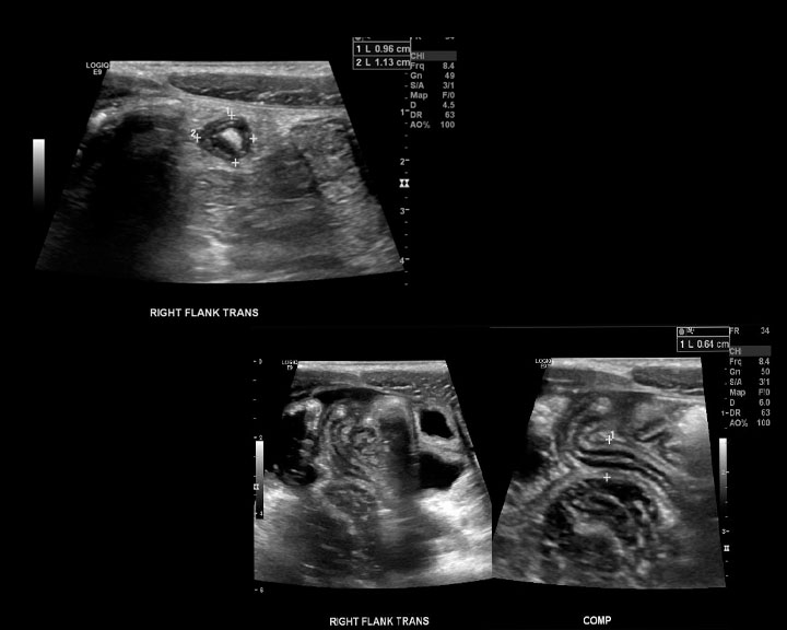 <p>Acute Appendicitis on Ultrasound