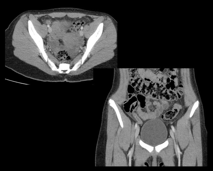 <p>Early Acute Appendicitis on Computed Tomography