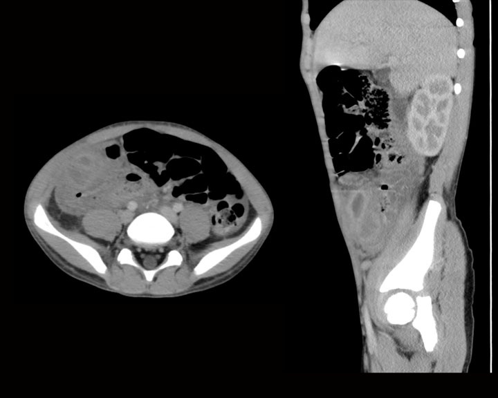 <p>Acute Appendicitis With Developing Abscess on Computed Tomography