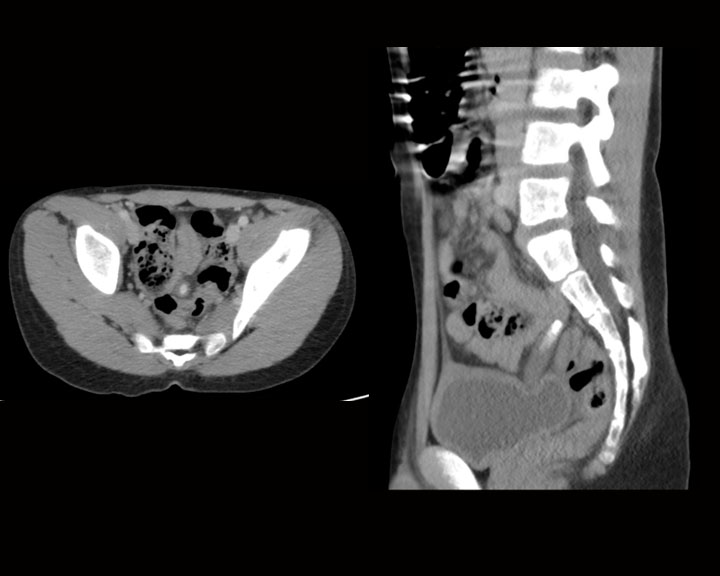<p>Early Acute Appendicitis With Appendicolith
