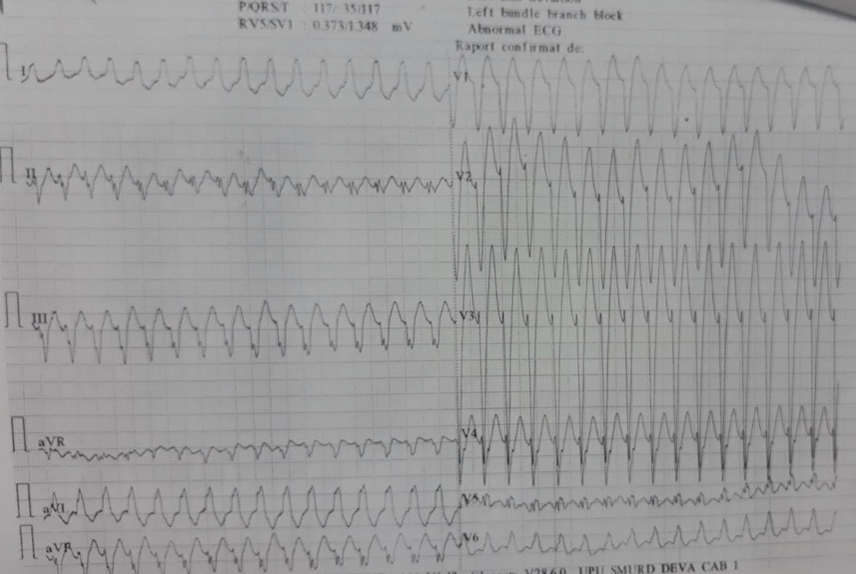 <p>Ischemic Ventricular Tachycardia in a Patient With a Previous Inferior Myocardial Infarction