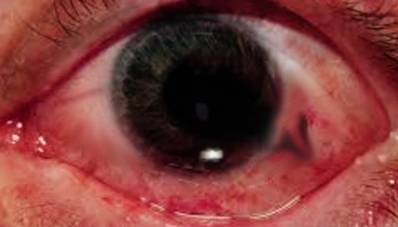 <p>Traumatic Globe Rupture