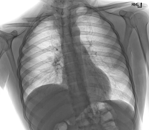 <p>Right Clavicle Fracture