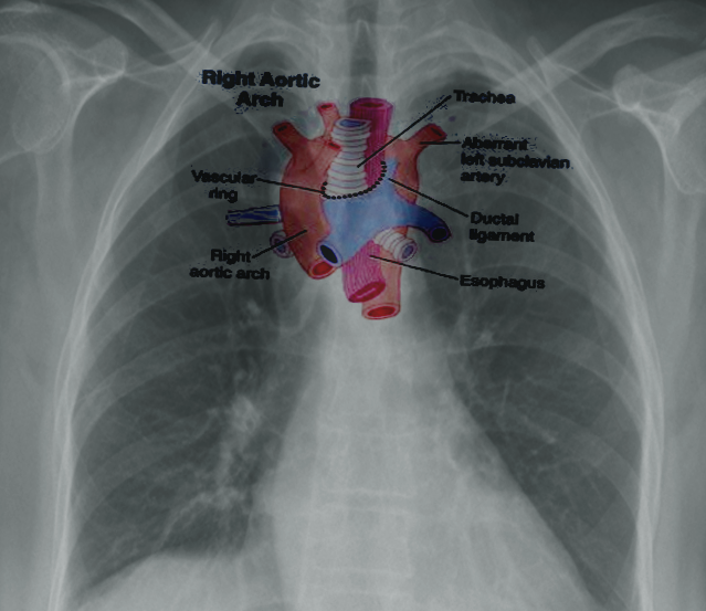 <p>Right Aortic Arch.</p>