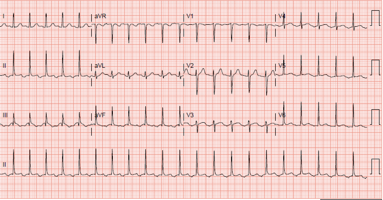 <p>Electrocardiogram of a Long RP Narrow Complex Tachycardia