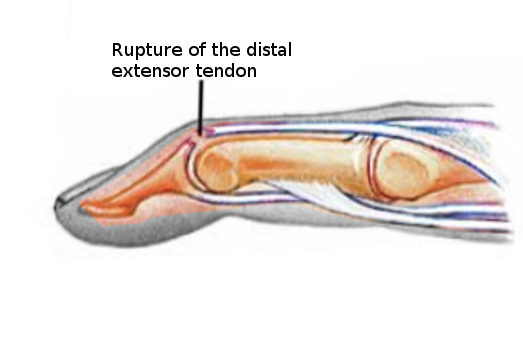<p>Mallet Finger Injury