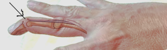 <p>Mallet Finger Pathophysiology