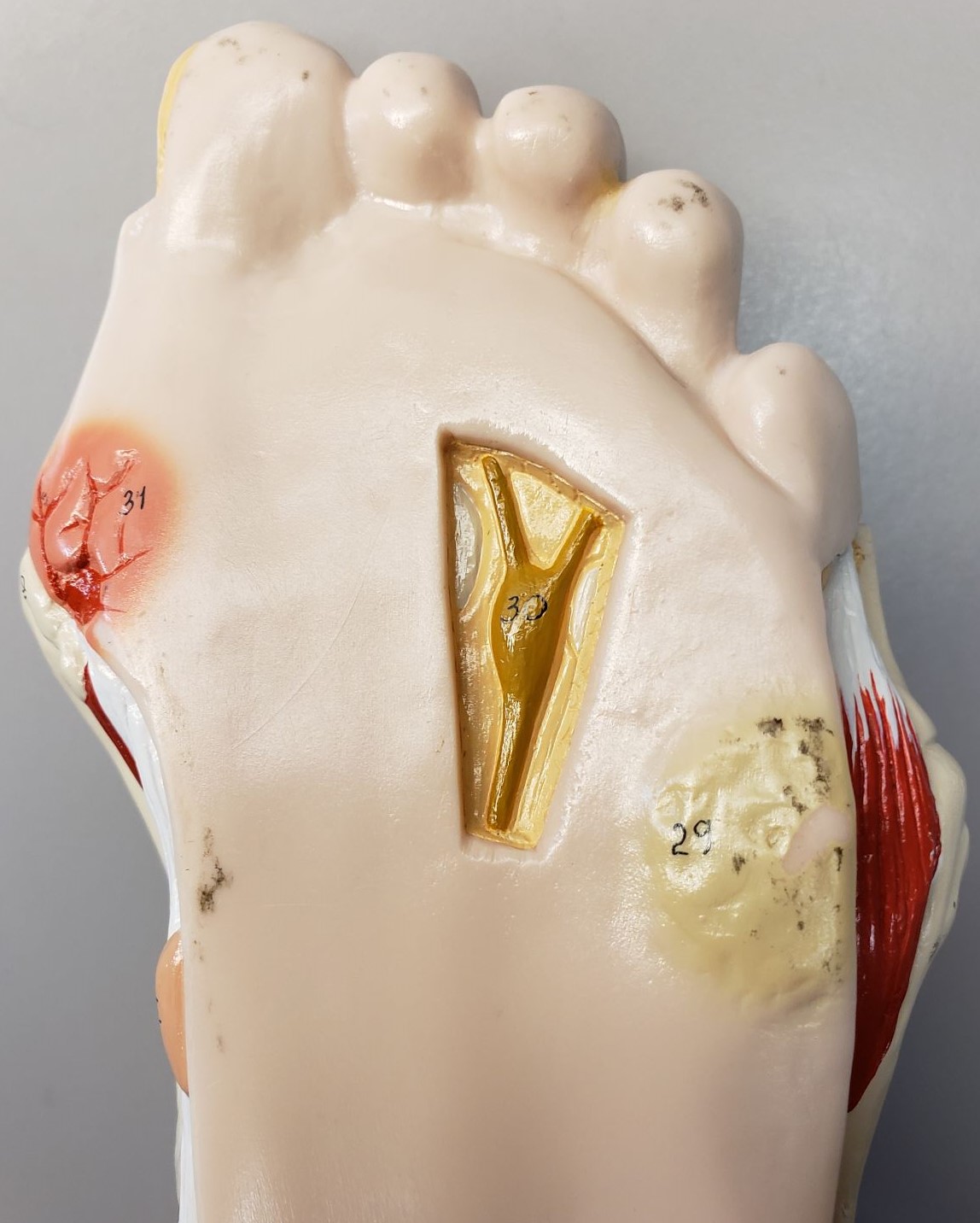<p>Anatomical Model of a Diabetic Foot