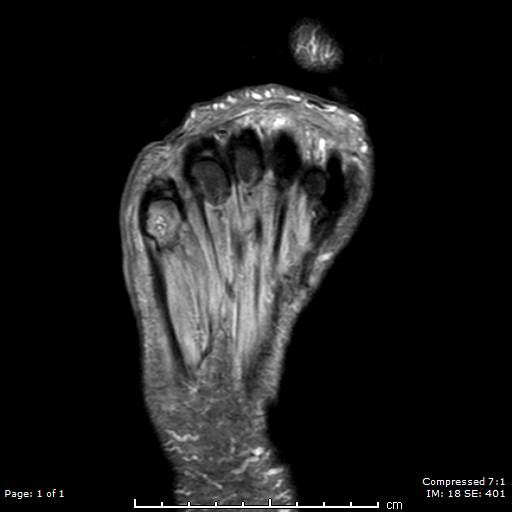 <p>Right Foot Osteomyelitis