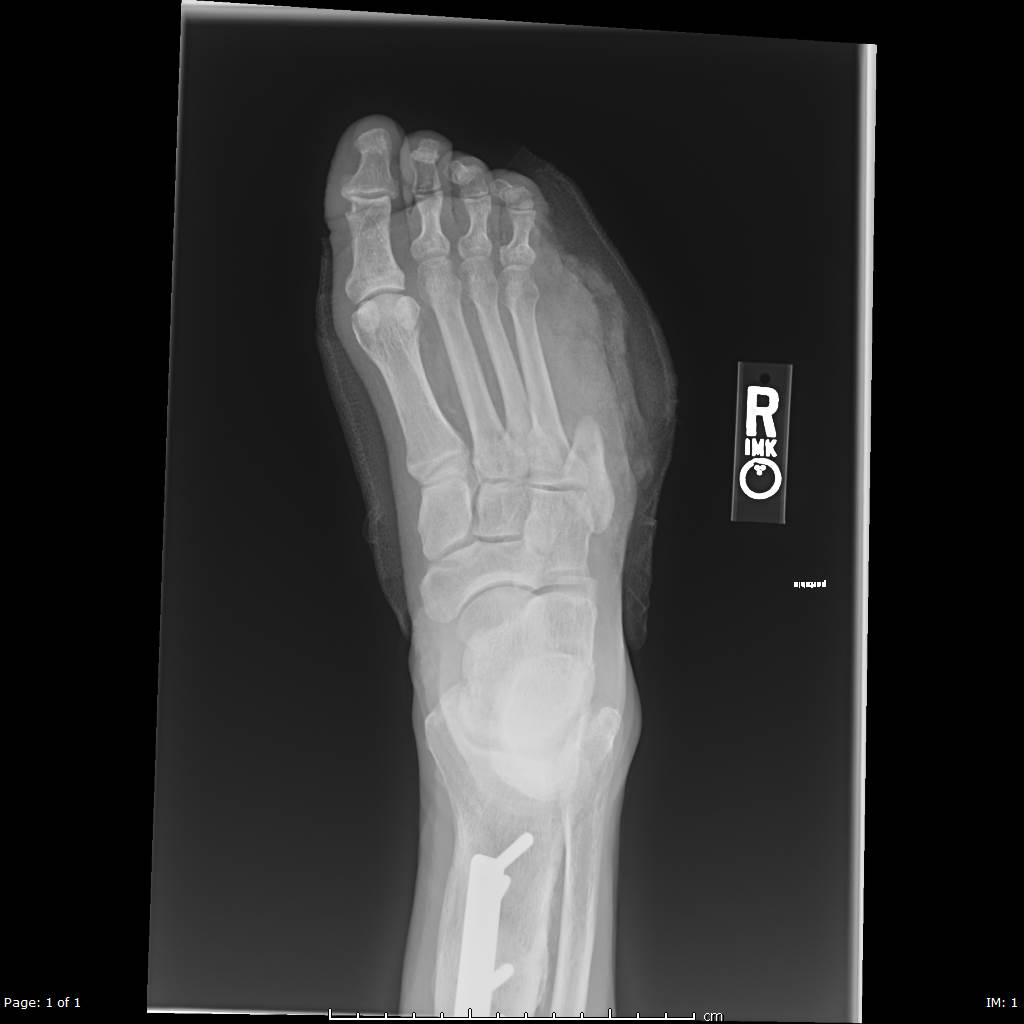 <p>Right Foot Radiograph
