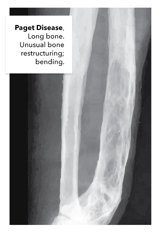 <p>Paget Disease of the Long Bone.&nbsp;Imaging demonstrating Paget disease of the long bone.</p>