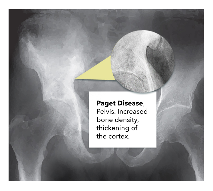 <p>Paget Disease Pelvis. Image demonstrating EMPD within the pelvis.</p>