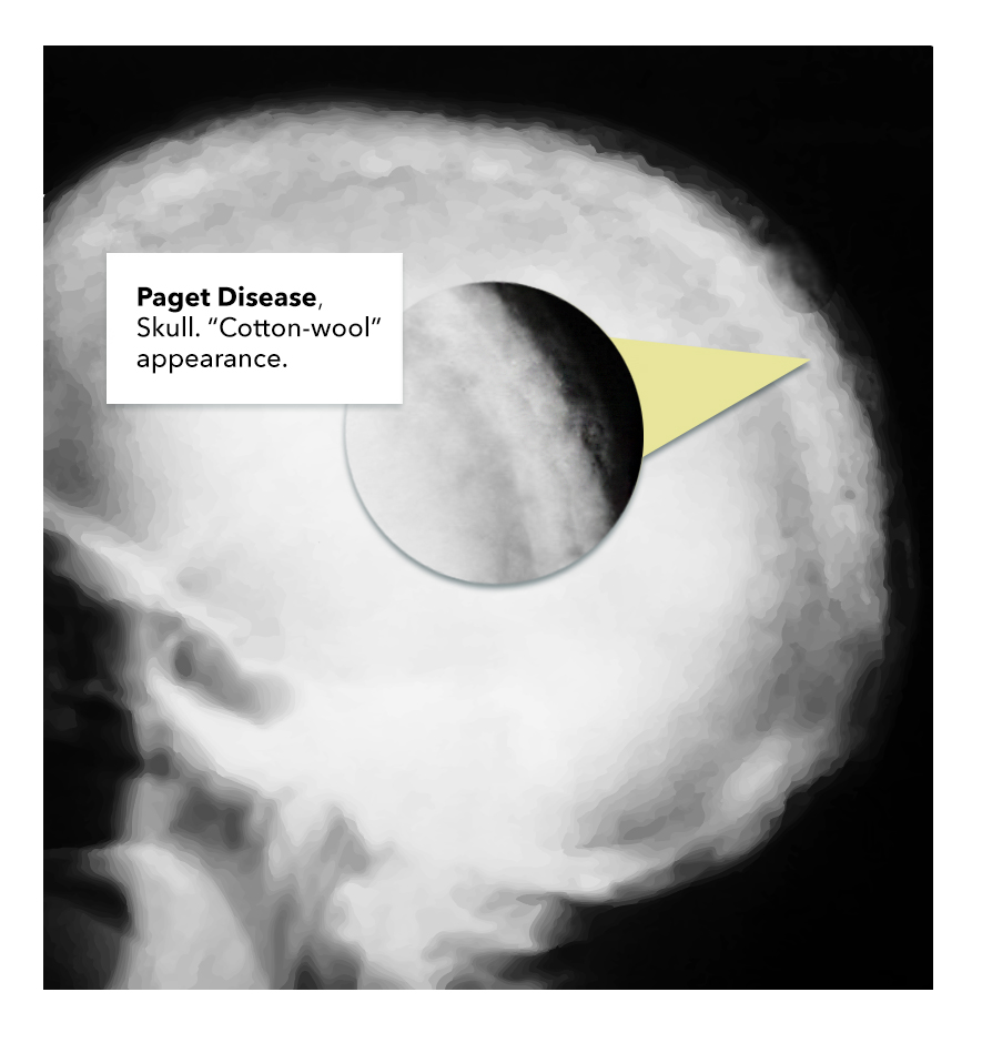 <p>Paget Disease Skull. Image demonstrating EMPD within the skull.</p>