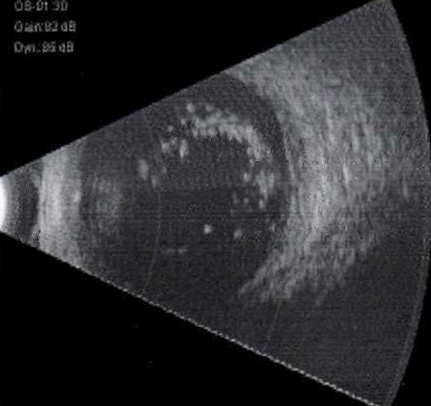 <p>B-Scan Ultrasound of an Eye with Asteroid Hyalosis