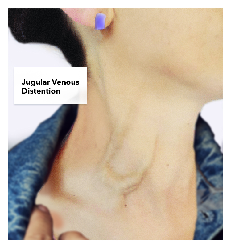 <p>Jugular Venous Distention.</p>