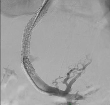 <p>Portal Venogram via Transjugular Intrahepatic Portosystemic Shunt