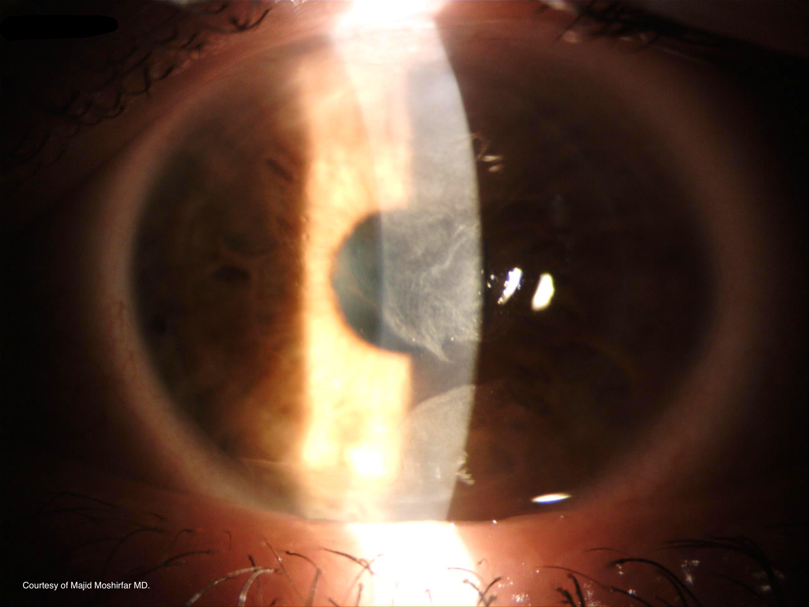 <p>Advancing Wavelike Epitheliopathy on Slit Lamp Examination