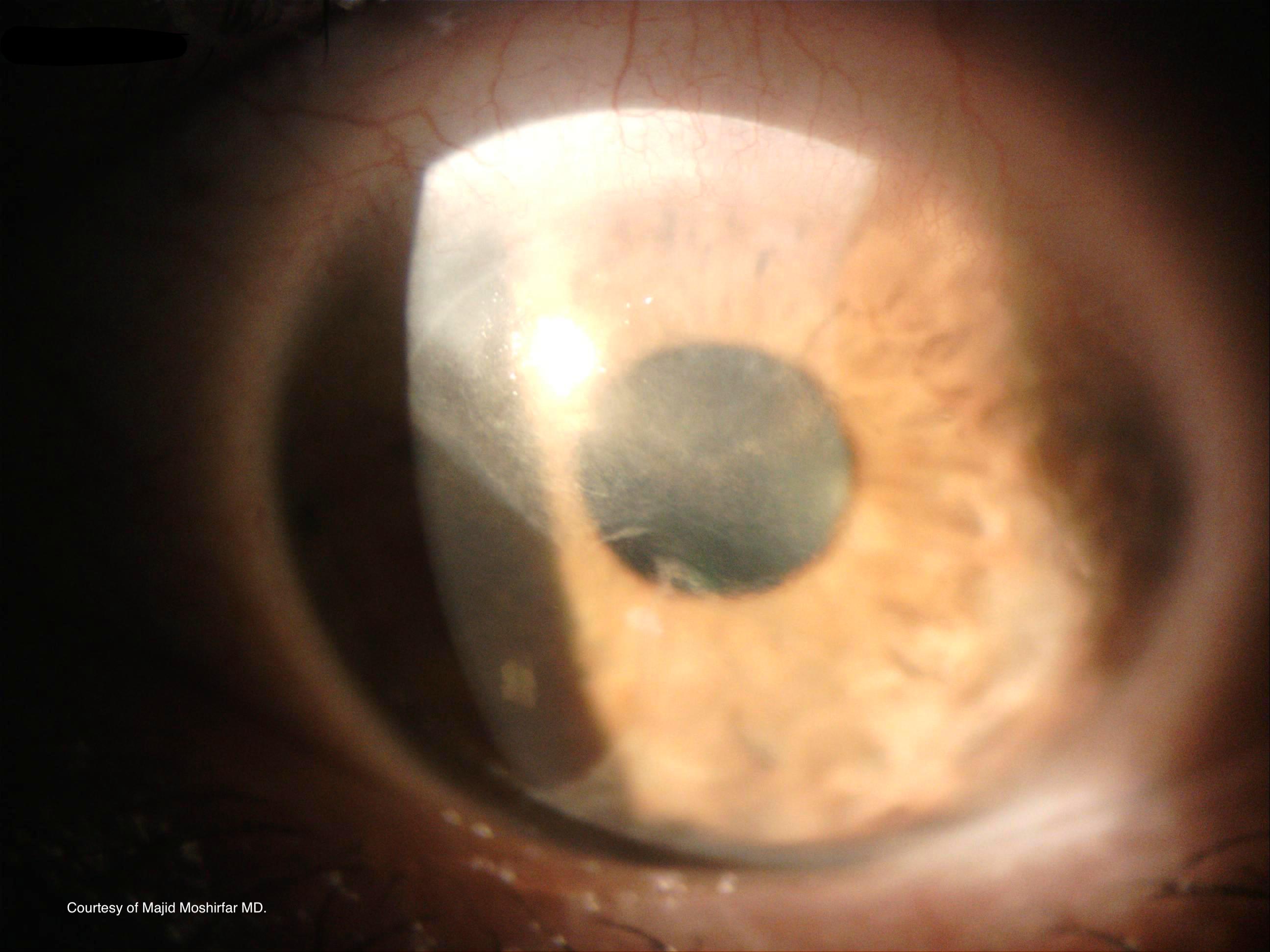 <p>Subepithelial Haze on Slit Lamp Examination