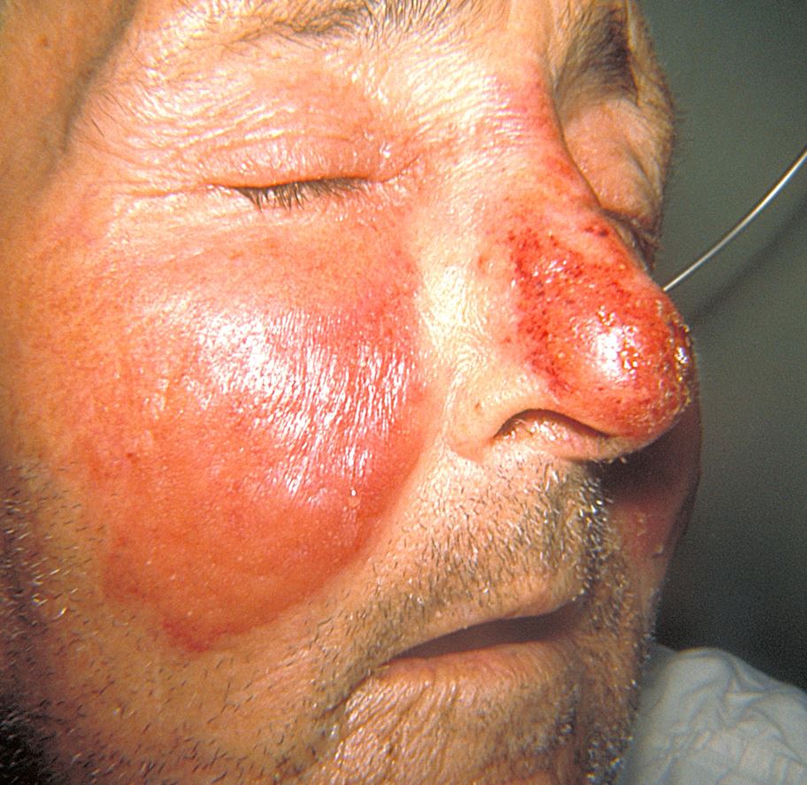 <p>Erysipelas Rash.</p>