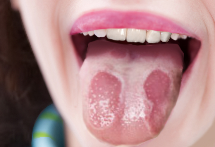 <p>Geographic Tongue.</p>