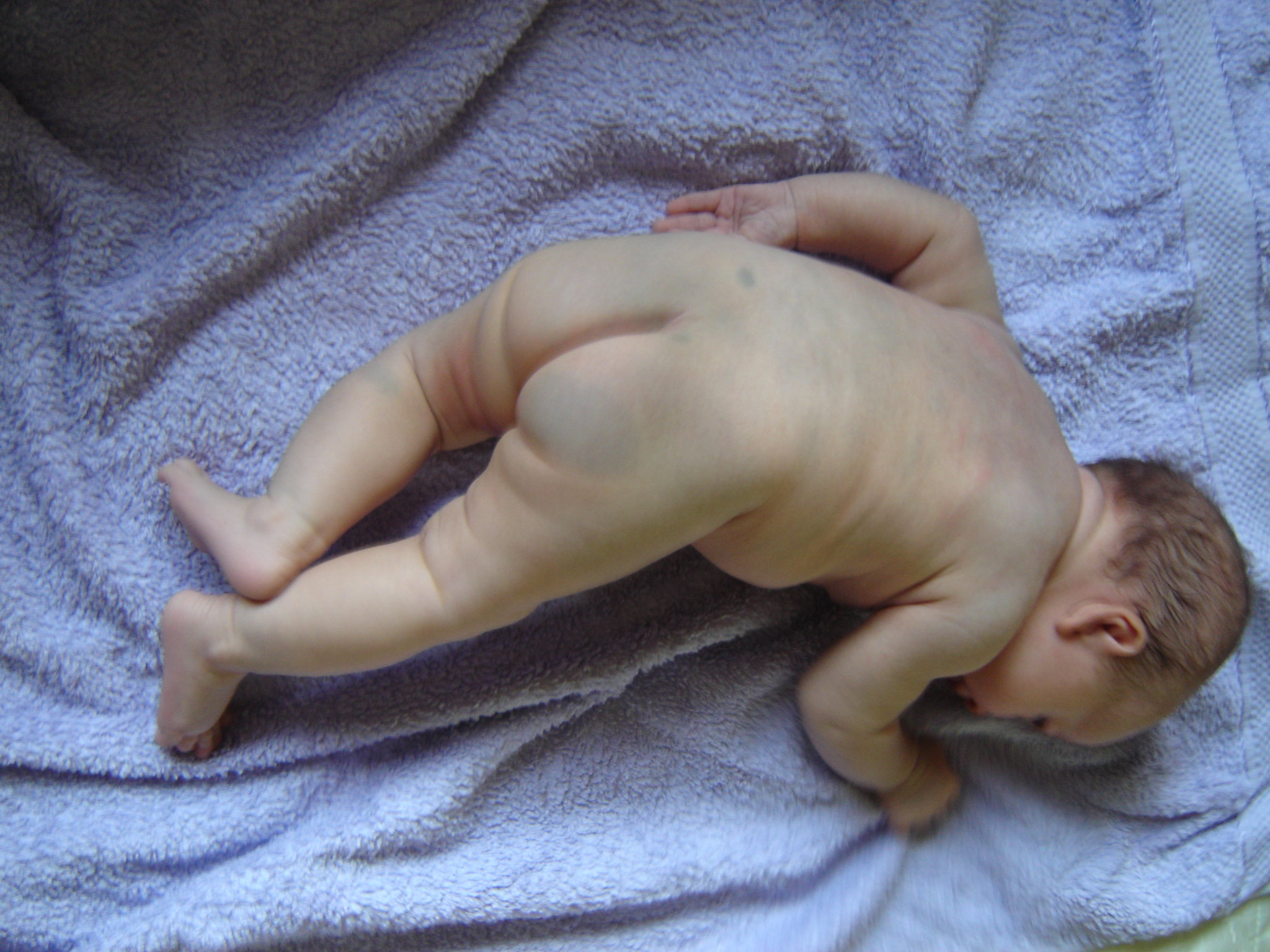 Congenital dermal melanocytosis
My fairest baby but she has the most prominent congenital dermal melanocytosis (Mongolian spots) on her back thanks to her Polynesian genes