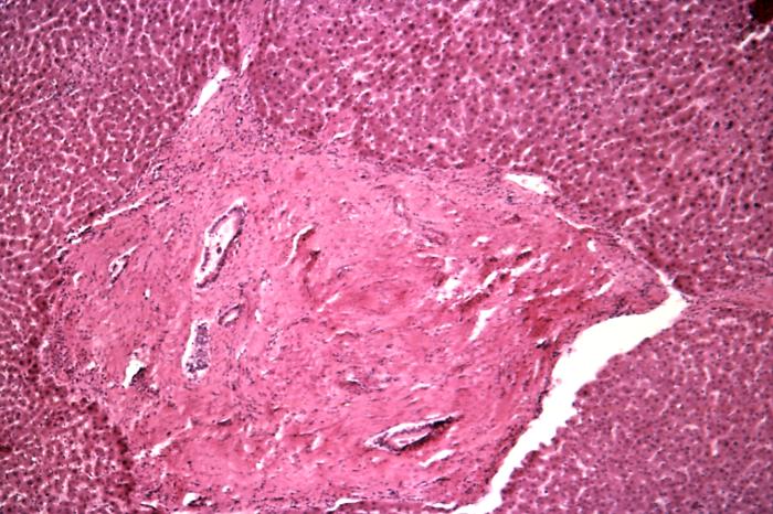 <p>Hepatic Schistosomiasis