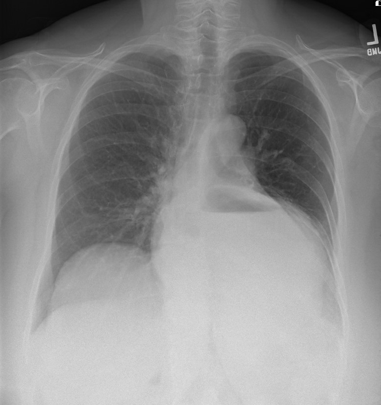 <p>Radiographic Appearance of a Mixed Paraesophageal Hernia