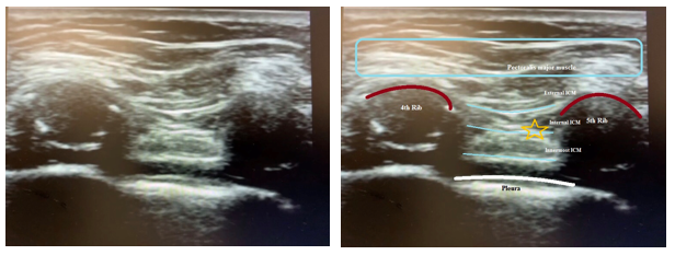 <p>Intercostal Nerve Block, Sonogram