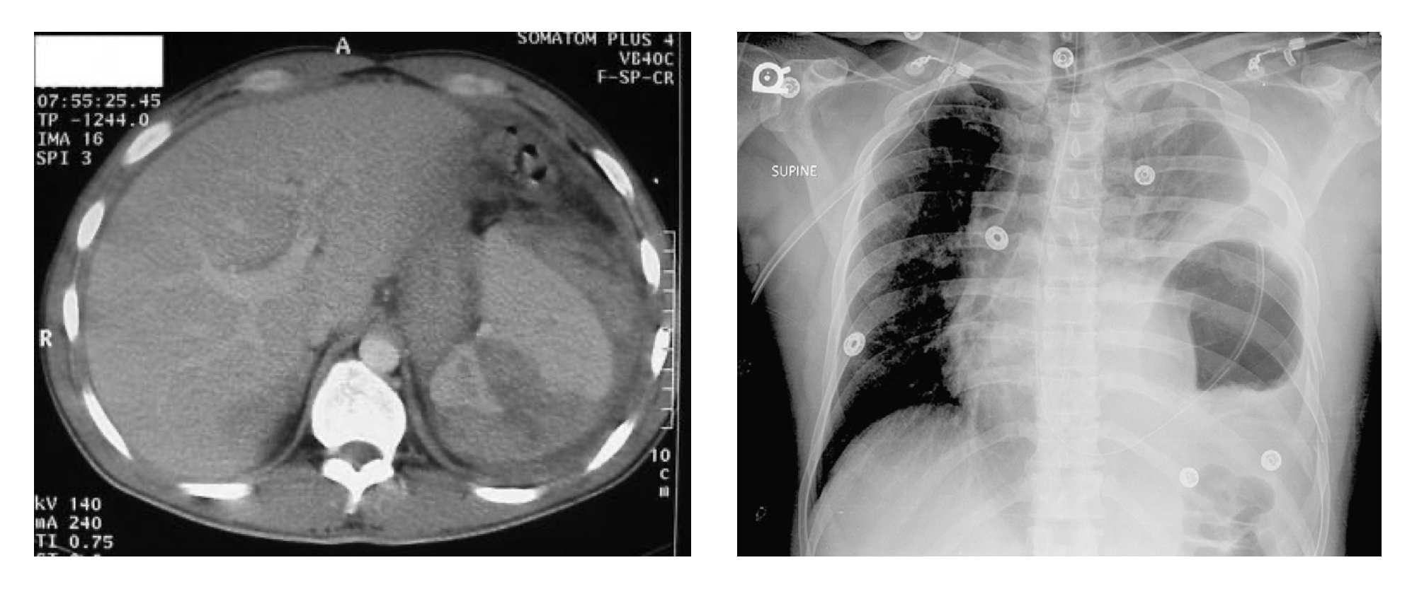 <p>Suspected Splenic Injury, Comparative Analysis of Computed Tomography (CT) and Chest X-ray (CXR) Imaging Findings