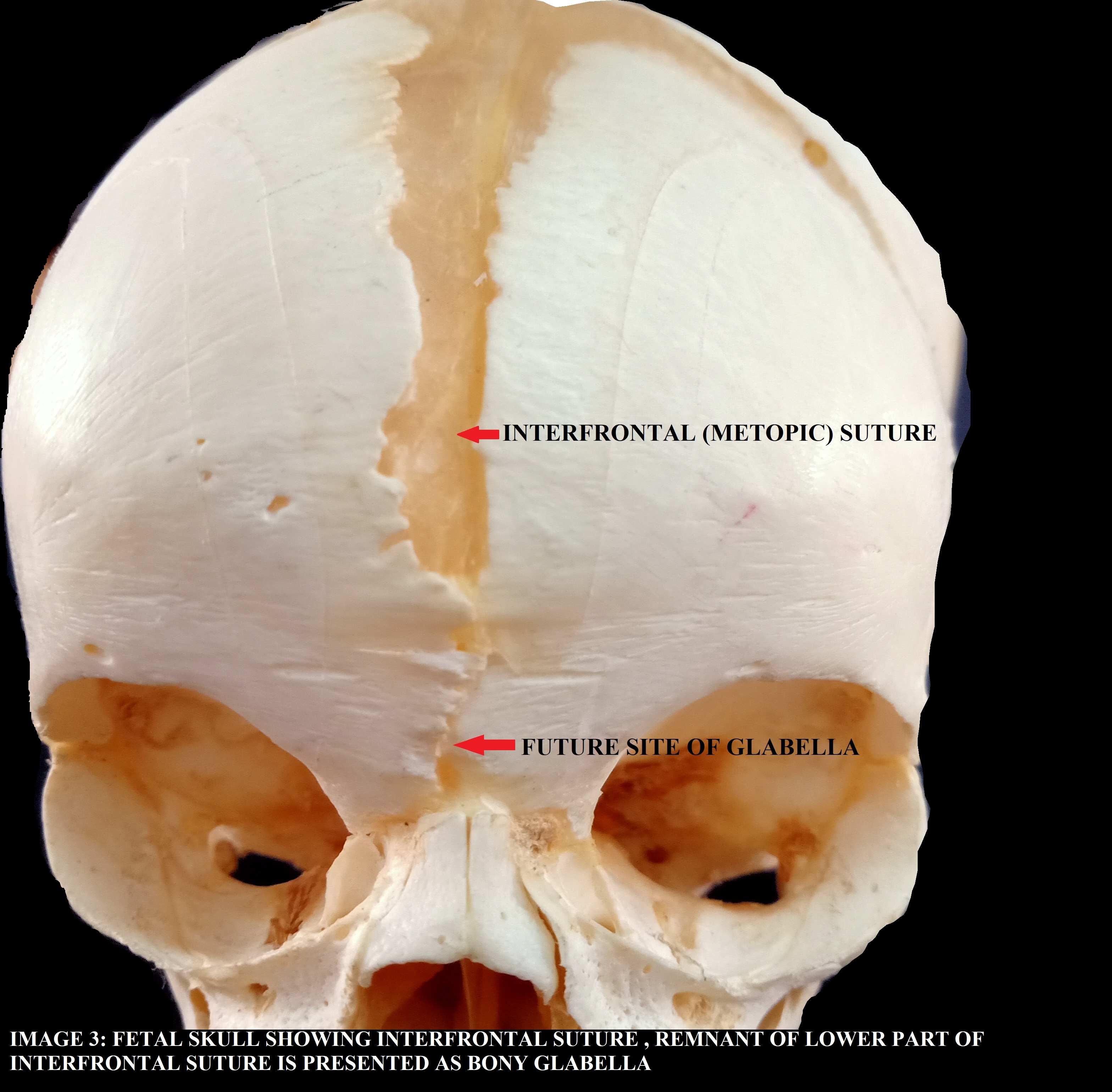 <p>Interfrontal Suture