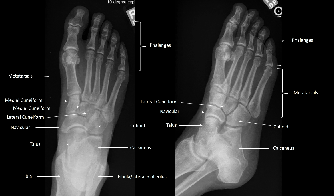 <p>Anteroposterior and Oblique Radiographs of the Foot