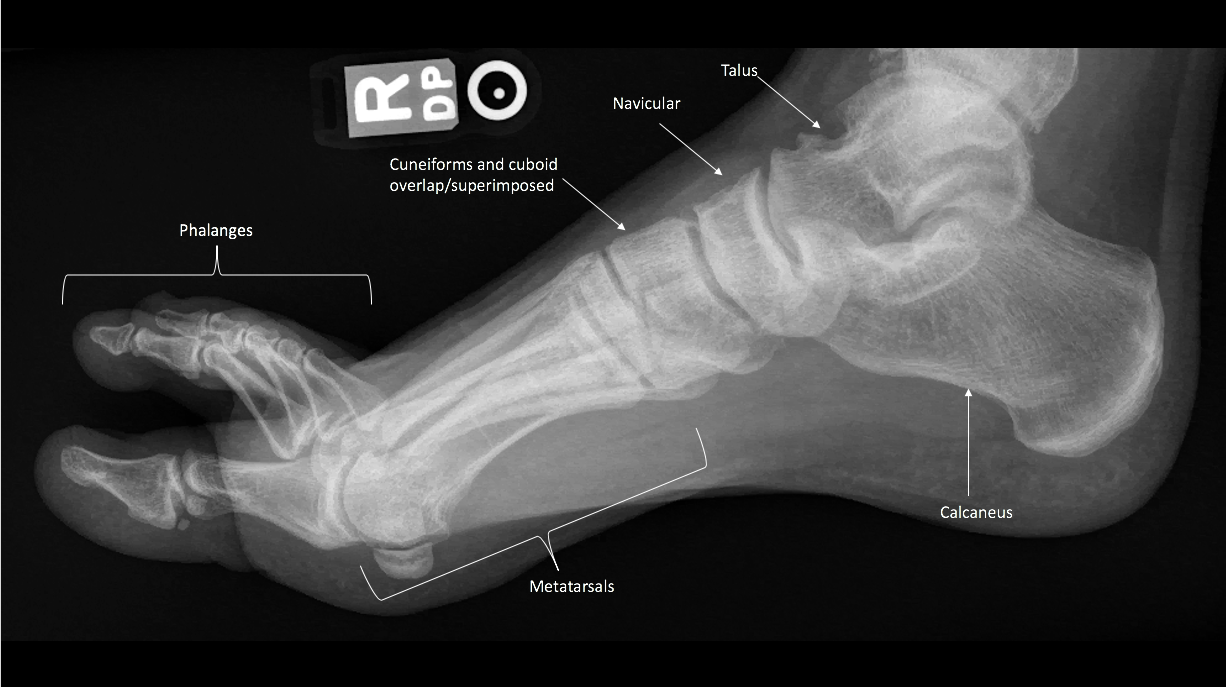 <p>Lateral Radiograph of the Right Foot
