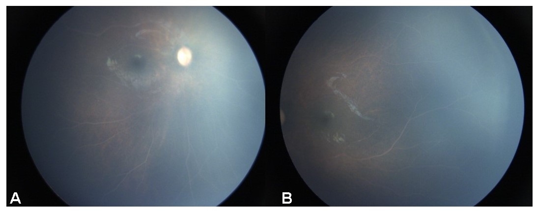 <p>Lipemia Retinalis Fundus Appearance