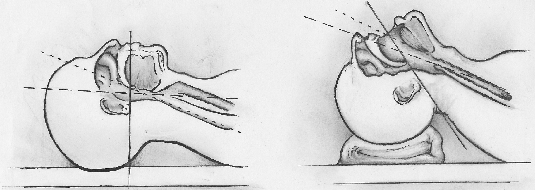 <p>Sniffing Position for Airway Alignment