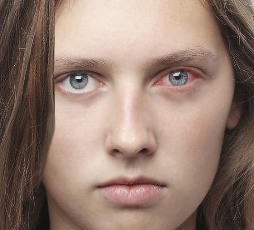 <p>Allergic Conjunctivitis.</p>