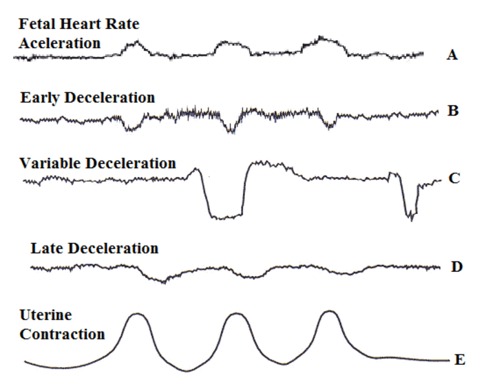<p>Fetal Heart Rate Terminology