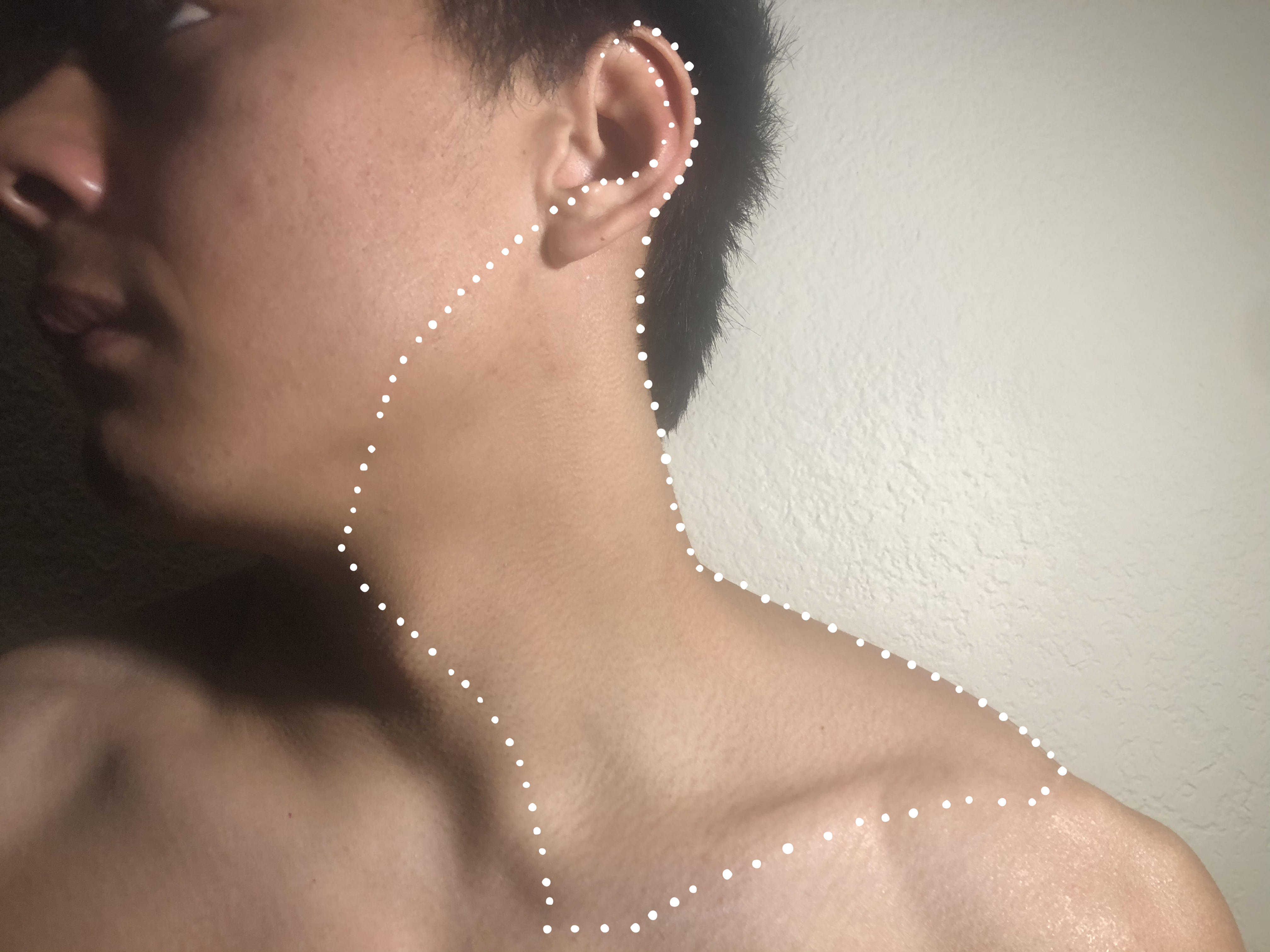 <p>Area Covered by a Superficial Cervical Plexus Block
