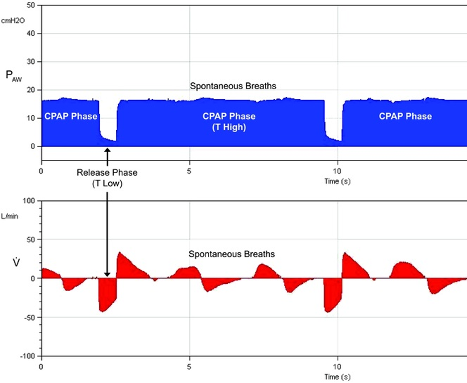 <p>Airway Pressure Release Ventilation Pressure Cycles with Superimposed Spontaneous Breathing