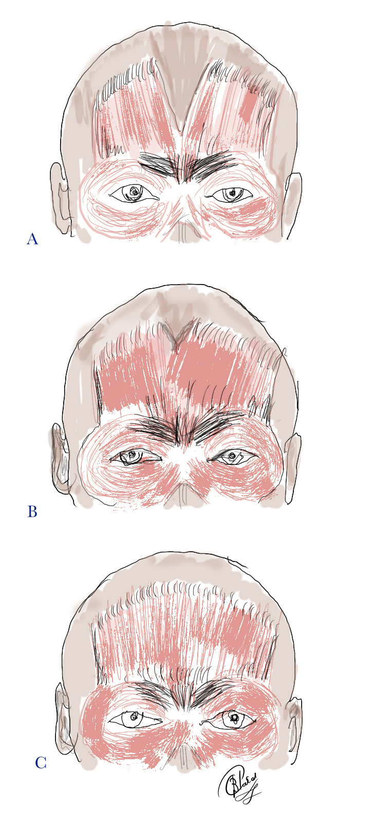 The Fronatalis Muscle: Bifurcation of the frontalis muscle may be 
A
