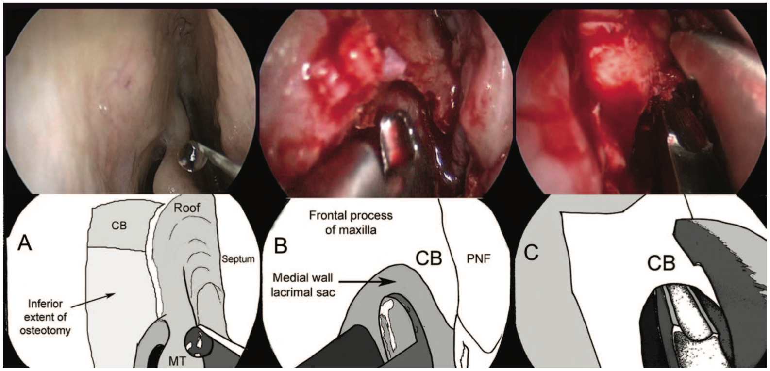 Bony Osteotomy in an Endoscopic Dacryocystorhinostomy: A, The right lateral nasal wall prior to surgery with a schematic illustration showing the underlying position of the osteot-
omy