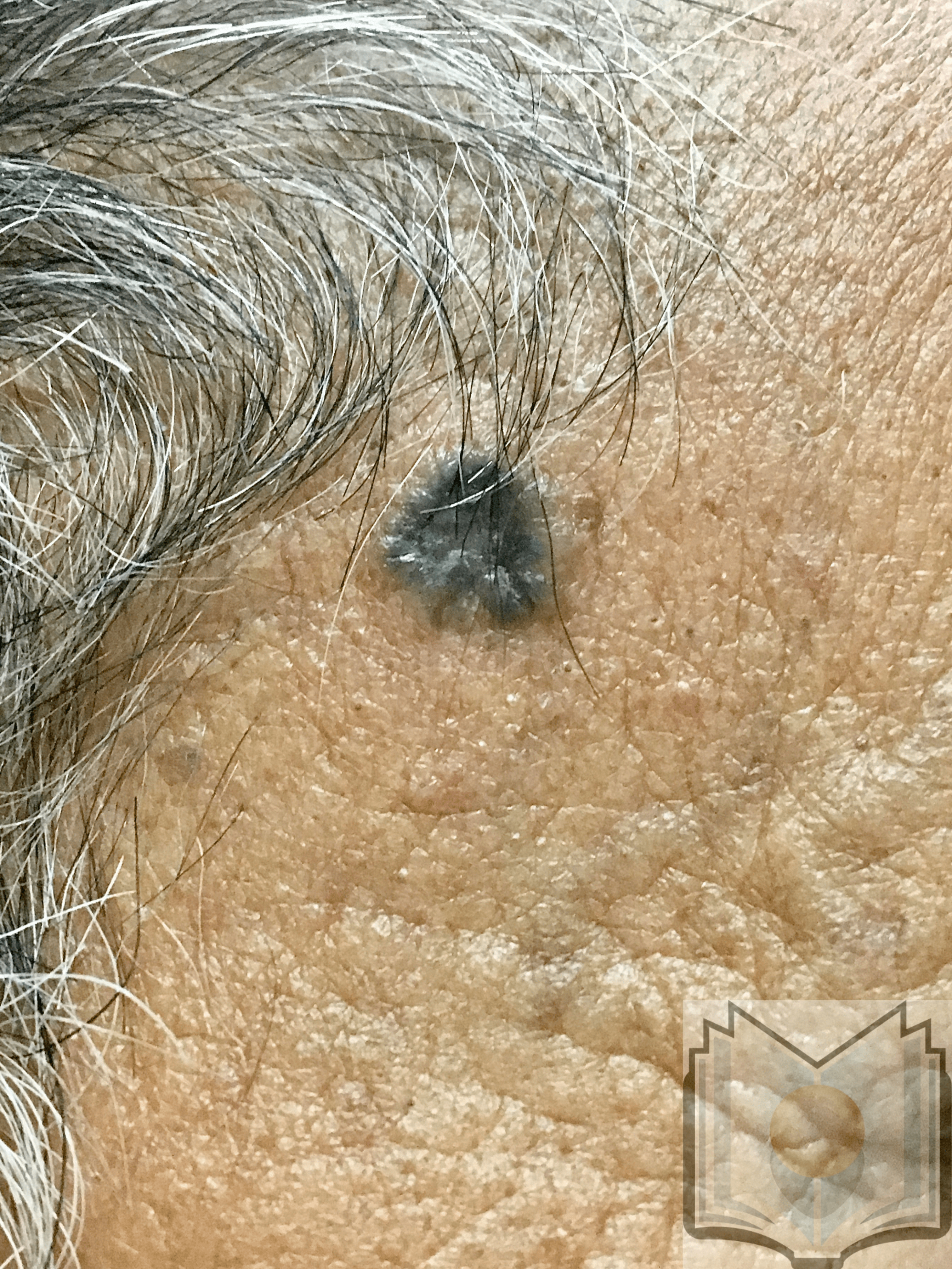 <p>Basal Cell Cancer