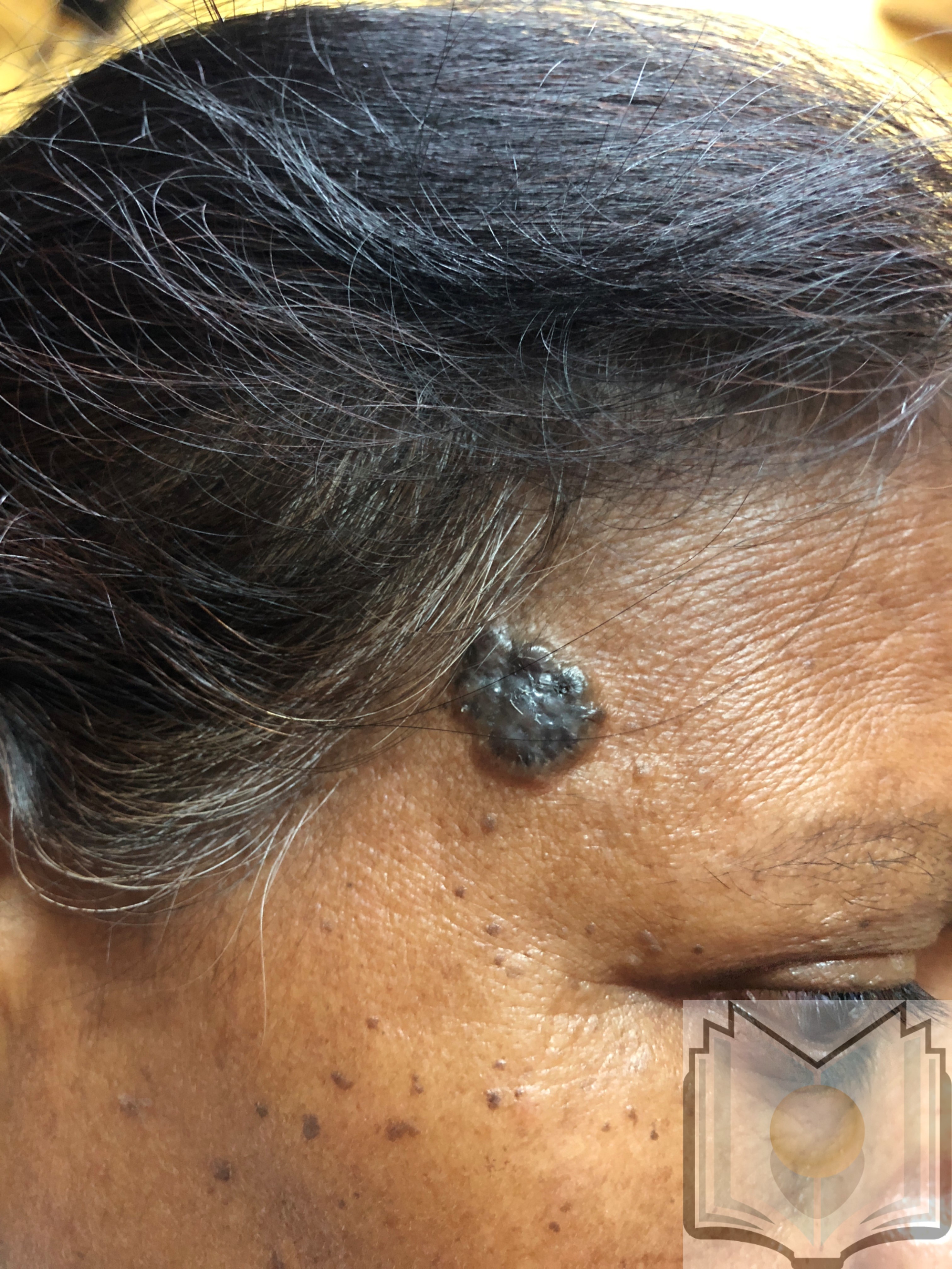 <p>Pigmented Basal Cell&nbsp;Carcinoma of Temple