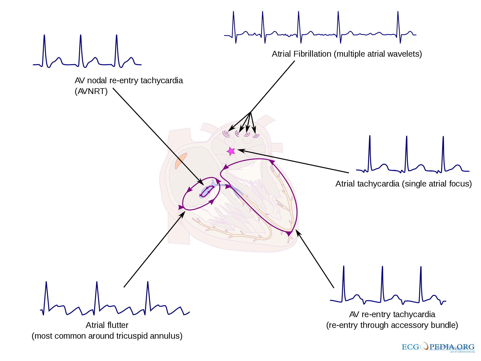 <p>Common Atrioventricular Node&ndash;Related Supraventricular Arrhythmias