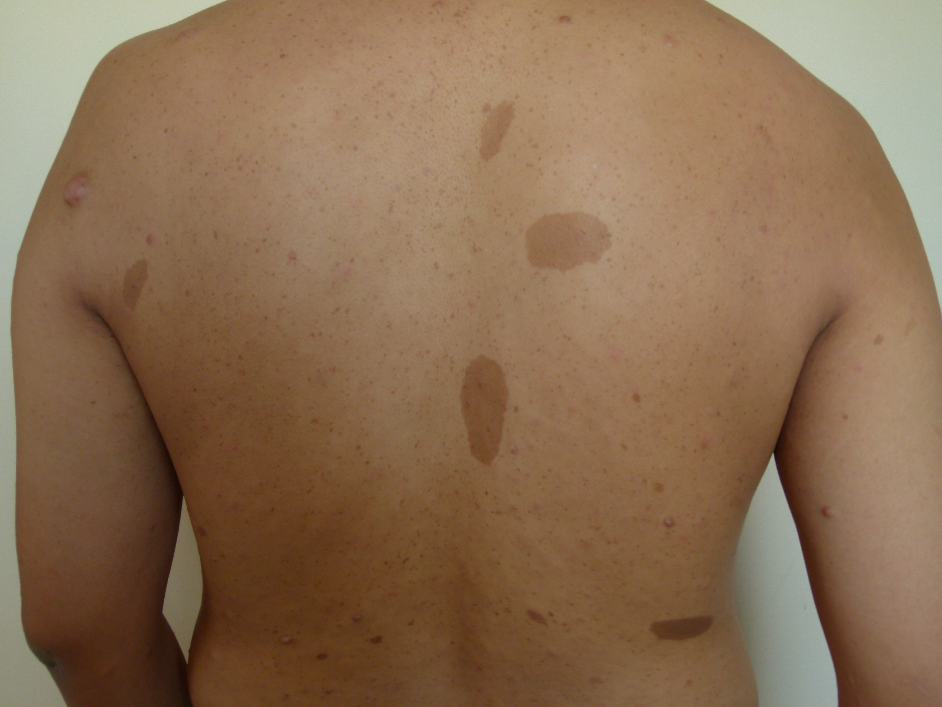 <p>Caf&eacute; au Lait Macules of the Posterior Trunk