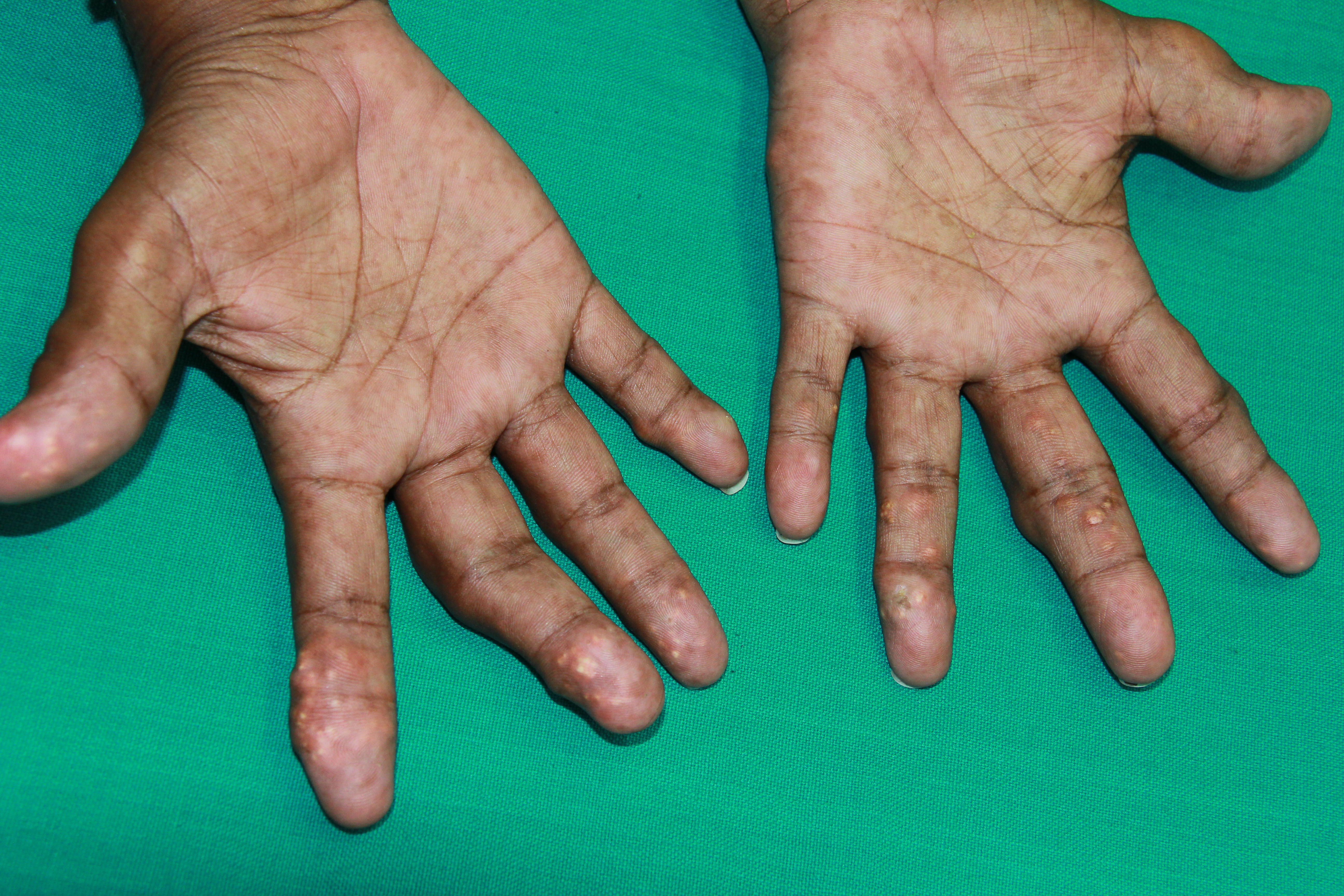 <p>Tophaceous Gout Affecting the Hands